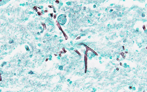 9C2 Mucormycosis (Case 9) GMS 2A