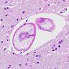 2A3 Meningoencephalitis, eosinophilic, necrotizing, parasite (Image from virtual slide AANP Dx Slide 2011-6) H&E 6A copy