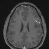 Neurocysticercosis