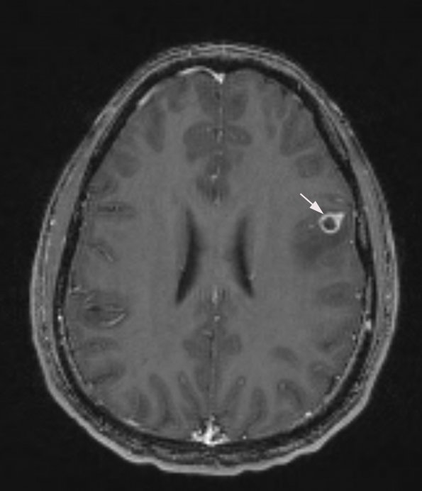 1A1 Cysticercosis (Case 1) T1 W 4 - Copy