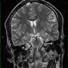 1A2 Cysticercosis (Case 1) T2 HIRES 2 - Copy