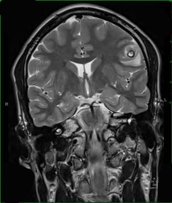 1A2 Cysticercosis (Case 1) T2 HIRES 2 - Copy