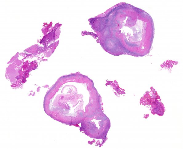 1B1 Cysticercosis (Case 1) H&E whole mountA