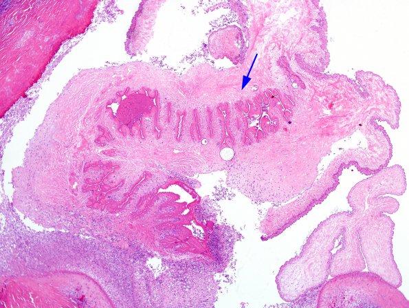 1B2 Cysticercosis (Case 1) H&E 4X