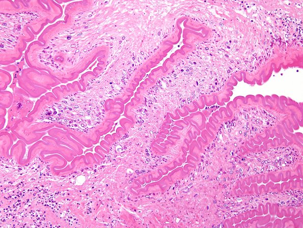 1B3 Cysticercosis (Case 1) H&E 3