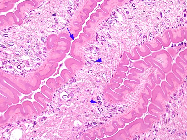 1B4 Cysticercosis (Case 1) H&E 2