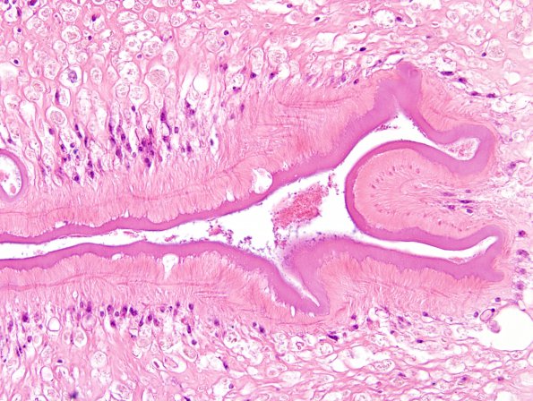 1B5 Cysticercosis (Case 1) H&E 8