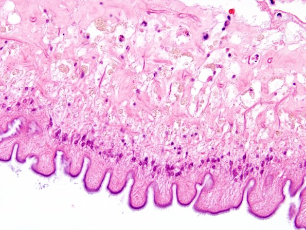 1B6 Cysticercosis (Case 1) H&E 11A