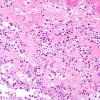 1B8 Cysticercosis (Case 1) H&E 1