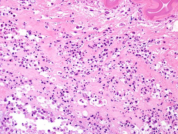 1B8 Cysticercosis (Case 1) H&E 1