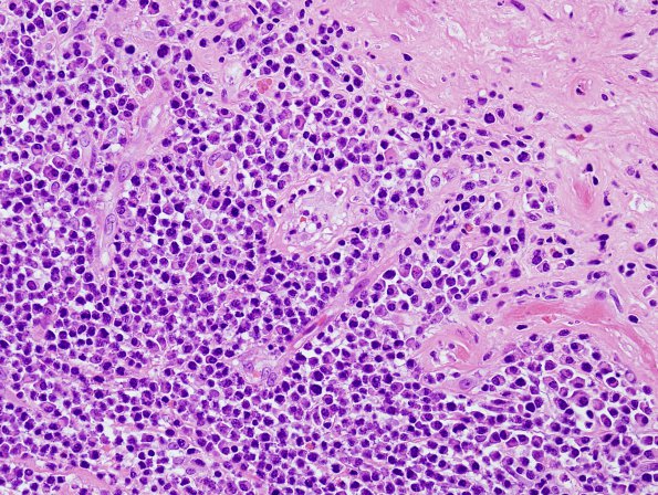 1B8 Cysticercosis (Case 1) H&E 6