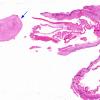 2A1 Cysticercosis (Case 2) H&E whole mount