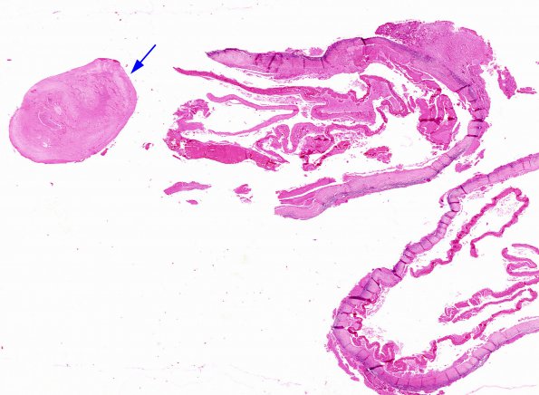 2A1 Cysticercosis (Case 2) H&E whole mount