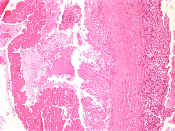 2A2 Cysticercosis (Case 2) H&E 3