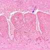 2A3 Cysticercosis (Case 2) H&E