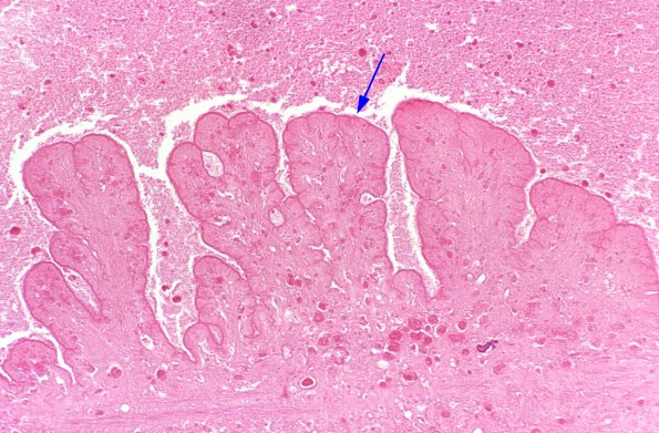 2A3 Cysticercosis (Case 2) H&E