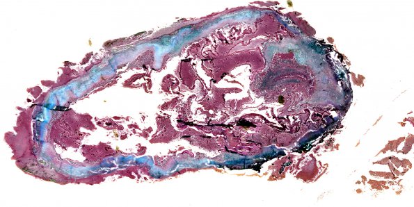 2B1 Cysticercosis (Case 2) Trichrome whole mount AA