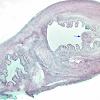 2B2 Cysticercosis (Case 2) GMS 4