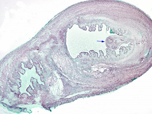 2B2 Cysticercosis (Case 2) GMS 4