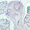 2B3 Cysticercosis (Case 2) GMS 2