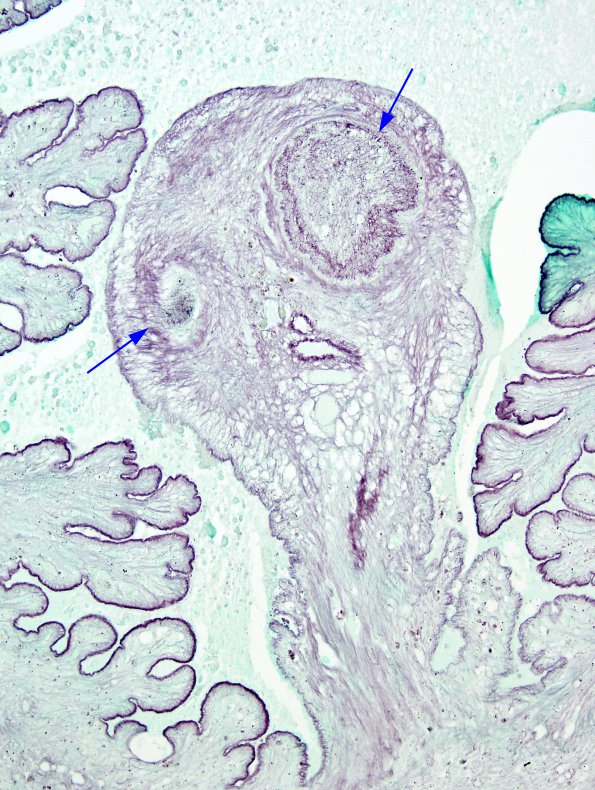 2B3 Cysticercosis (Case 2) GMS 2