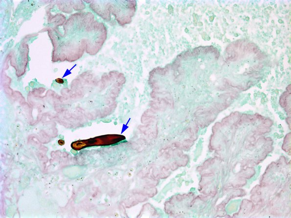 2B4 Cysticercosis (Case 2) hooklet