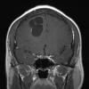 3A1 Cysticercosis (Case 3) T1W - Copy