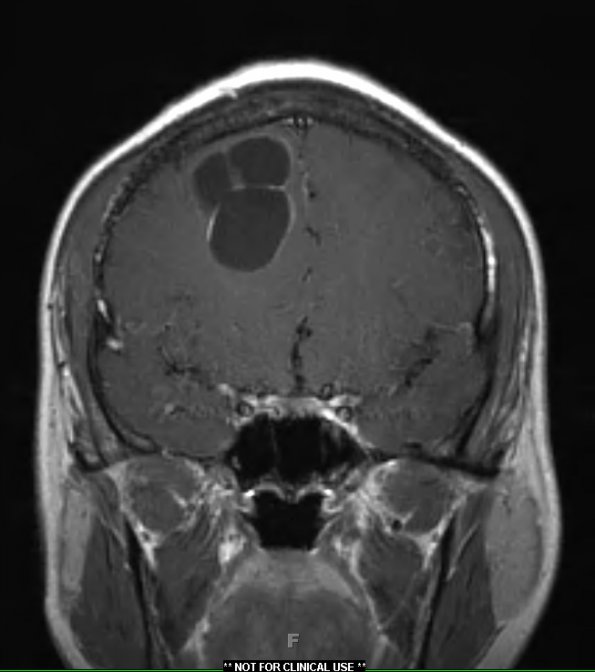 3A1 Cysticercosis (Case 3) T1W - Copy