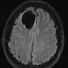 3A2 Cysticercosis (Case 3) Flair 1 - Copy