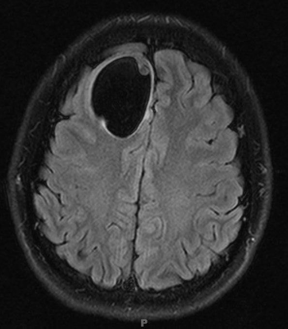 3A2 Cysticercosis (Case 3) Flair 1 - Copy