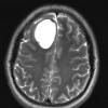 3A3 Cysticercosis (Case 3) T2 - Copy