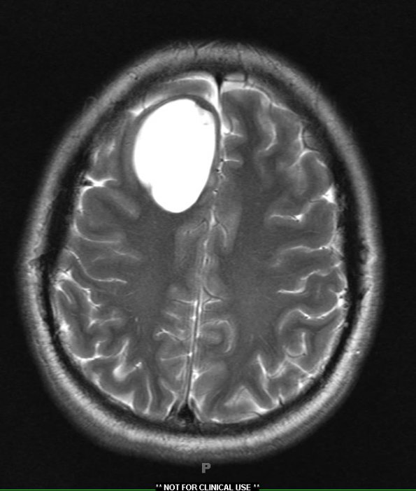 3A3 Cysticercosis (Case 3) T2 - Copy