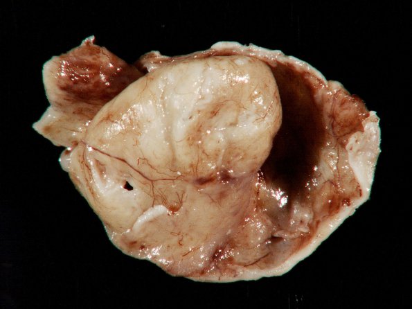 3B1 Cysticercosis (Case 3) Gross 4