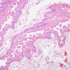 3C2 Cysticercosis (Case 3) H&E 1