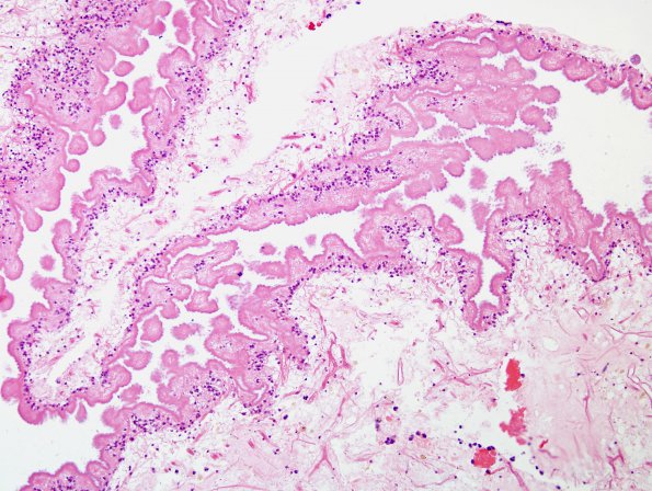 3C2 Cysticercosis (Case 3) H&E 1