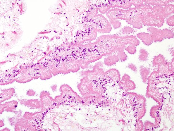 3C3 Cysticercosis (Case 3) H&E 2A