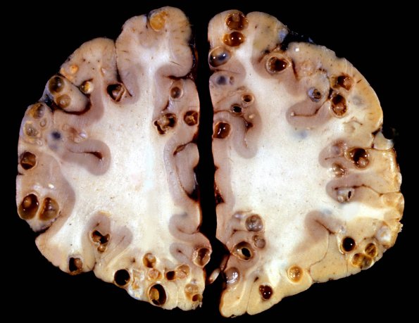 4A2 Cysticercosis (Case 4) 2