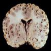 4A3 Cysticercosis (Case 4) 3