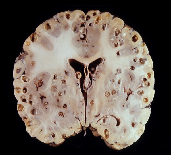 4A3 Cysticercosis (Case 4) 3