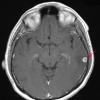 5A1 Cysticercosis, deceased (Case 5) T1 W - Copy