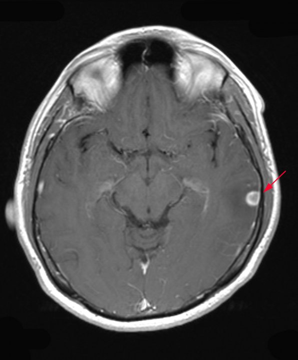 5A1 Cysticercosis, deceased (Case 5) T1 W - Copy