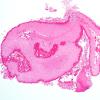 5B1 Cysticercosis, degenerated (Case 5) H&E 1A