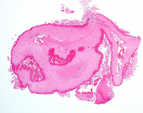 5B1 Cysticercosis, degenerated (Case 5) H&E 1A