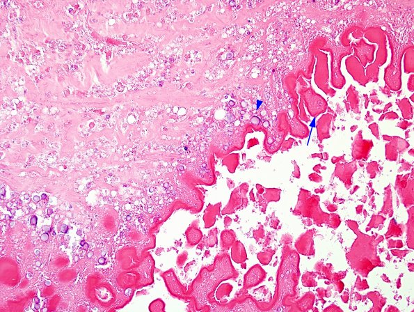 5B2 Cysticercosis, degenerated (Case 5) H&E 4