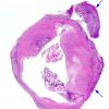 5B3 Cysticercosis, degenerated (Case 5) H&E whole mount