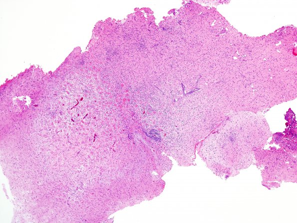 5B4 Cysticercosis, degenerated (Case 5) H&E 8