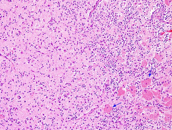 5B5 Cysticercosis, degenerated (Case 5) H&E 7