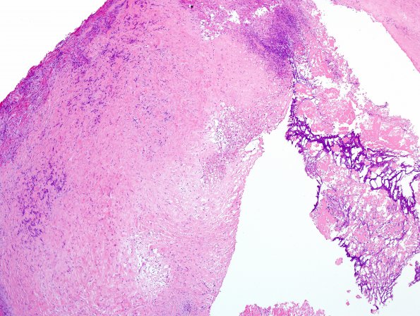 5B6 Cysticercosis, degenerated Case 5) H&E 12