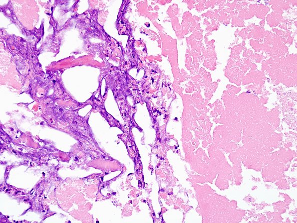 5B7 Cysticercosis, degenerated (Case 5) H&E 15