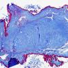 5C1 Cysticercosis, degenerated (Case 5) Trichrome 5 copy